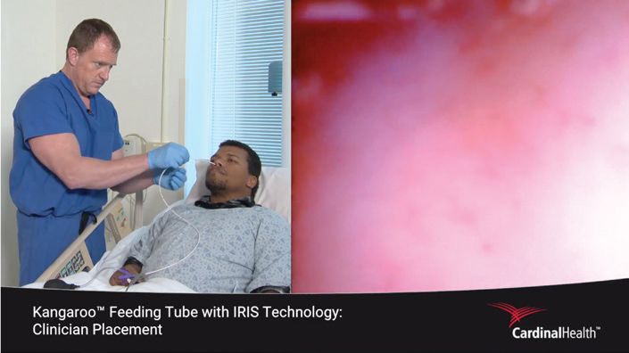Kangaroo™ Feeding Tube with IRIS Technology clinician placement.