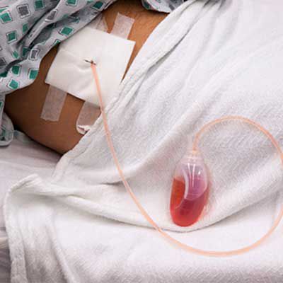 surgical wound drains